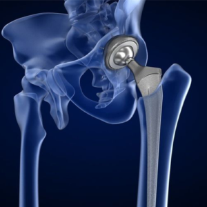 Hip Replacement Products